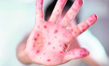 La OPS anunció que América no es más una región libre de transmisión endémica de sarampión | Salud