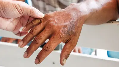 La OMS alertó la falta de control de la lepra debido a la pandemia del COVID-19 La OMS alertó la falta de control de la lepra debido a la pandemia del COVID-19