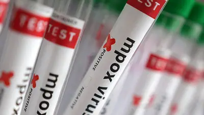 Francia identifica el primer caso de la nueva variante de viruela símica, según AFP Francia identifica el primer caso de la nueva variante de viruela símica, según AFP