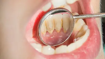 Sarro en los dientes. Sarro en los dientes.