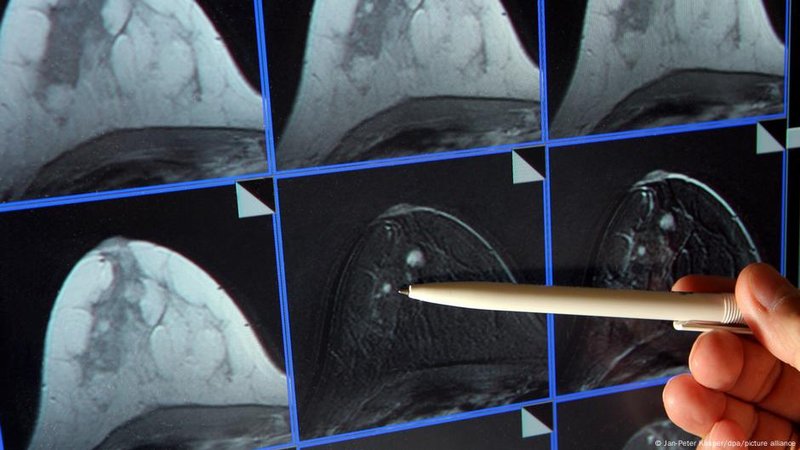 Avance revolucionario para la salud: logran predecir el cáncer de mama con Inteligencia Artificial