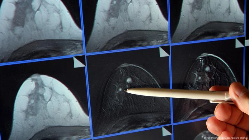Avance revolucionario para la salud: logran predecir el cáncer de mama con Inteligencia Artificial