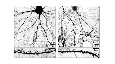Izqu neuronas normales. Der: neuronas modificadas con L-Dopa. Izqu neuronas normales. Der: neuronas modificadas con L-Dopa.