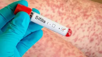 ¿La sífilis tiene cura? Qué dicen los expertos que advierten el aumento de casos ¿La sífilis tiene cura? Qué dicen los expertos que advierten el aumento de casos