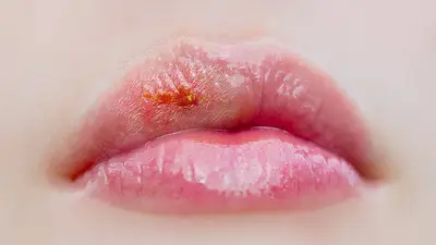 Salud, enfermedades, herpes labial Salud, enfermedades, herpes labial