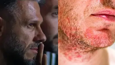 Qué es la dermatitis seborreica, el hongo de Martín Demichelis: causas, tratamientos y diagnóstico Qué es la dermatitis seborreica, el hongo de Martín Demichelis: causas, tratamientos y diagnóstico