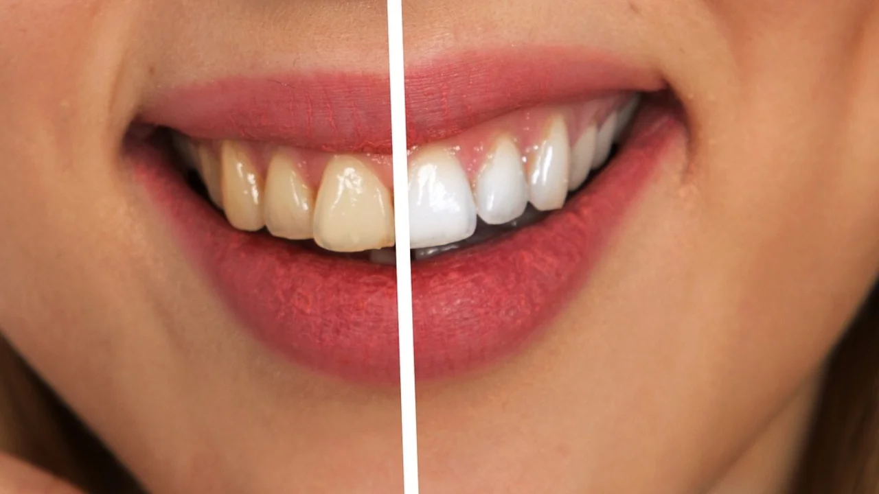 SALUD DENTAL: LO QUE NO SABÍAS SOBRE EL BLANQUEAMIENTO DENTAL EN CASA