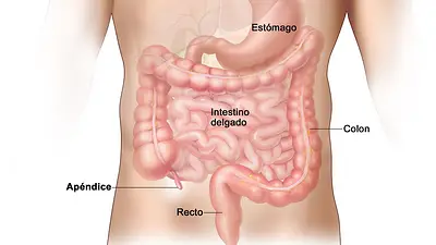 Apendicitis aguda: síntomas y tratamientos para esta infección Apendicitis aguda: síntomas y tratamientos para esta infección