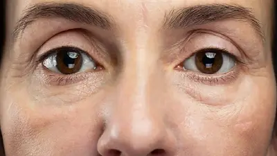 Ojeras. Ojeras.