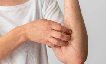 Reportan un caso de sarampión en el país en un hombre de 29 años | Salud