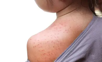 Qué es el sarpullido por calor en adultos y bebés: cómo detectarlo | Salud