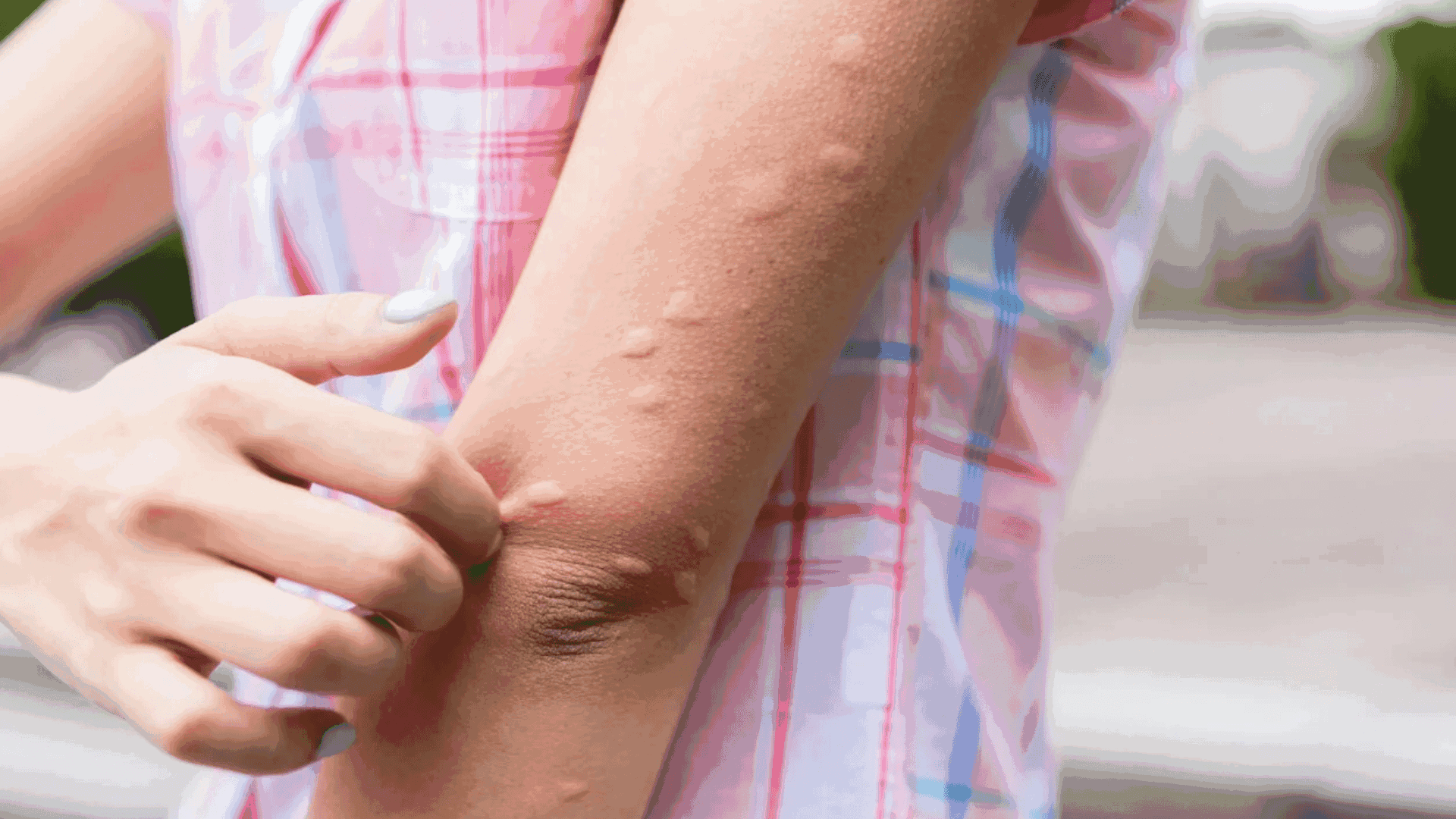 Esa mancha roja no siempre es un mosquito: cómo distinguir picaduras, sarpullidos y señales de alerta en el verano, según expertos