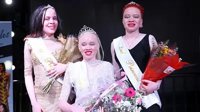 Zimbabue celebró su primer concurso de belleza Miss Albina Zimbabue celebró su primer concurso de belleza Miss Albina