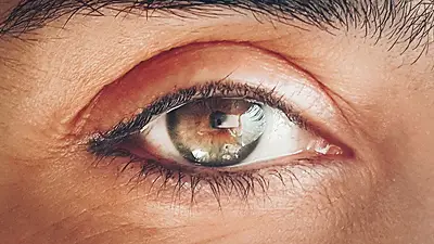 Glaucoma Glaucoma
