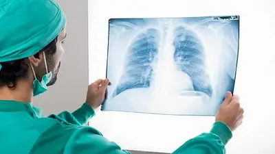 Fibrosis pulmonar Fibrosis pulmonar