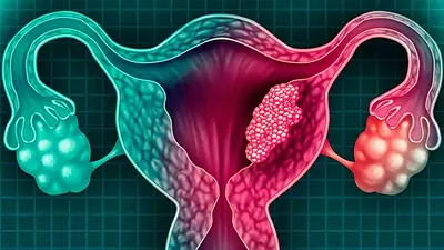 Cáncer de útero: qué es, cuáles son sus síntomas y cómo prevenirlo Cáncer de útero: qué es, cuáles son sus síntomas y cómo prevenirlo