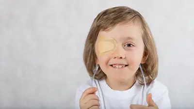 Ambliopía u "ojo vago" Ambliopía u "ojo vago"