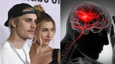 Qué es un ictus, la condición que padeció Hailey, la esposa de Justin Bieber
