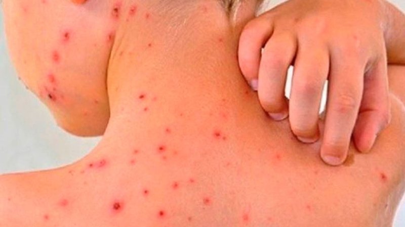 Dengue y vacaciones de verano: las recomendaciones para reforzar la prevención