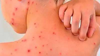 Dengue y vacaciones de verano: las recomendaciones para reforzar la prevención Dengue y vacaciones de verano: las recomendaciones para reforzar la prevención
