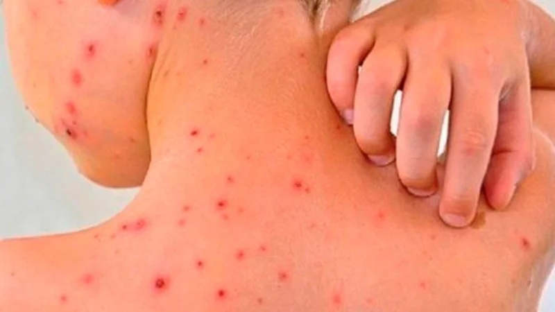 Dengue y vacaciones de verano: las recomendaciones para reforzar la prevención