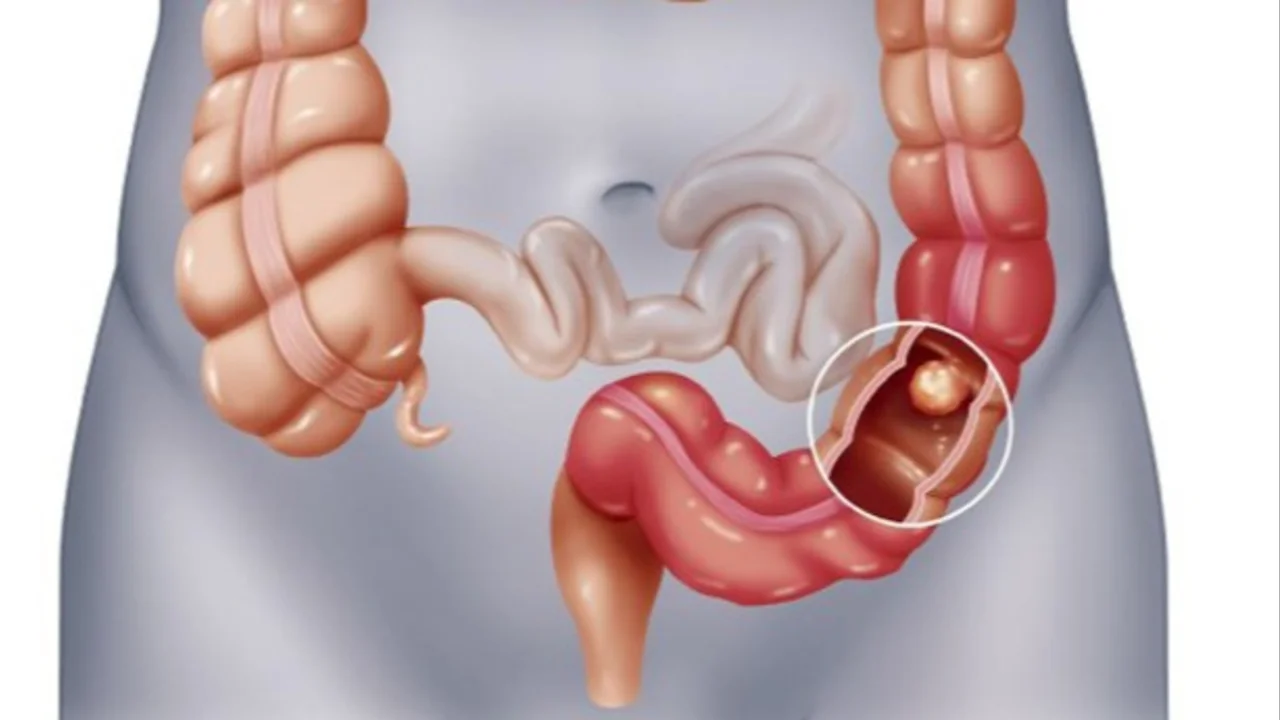 Día mundial del Cáncer de Colon. 