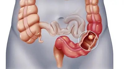 Día mundial del Cáncer de Colon. Día mundial del Cáncer de Colon.