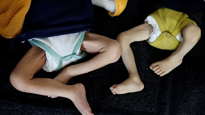 Hambre en Gaza: los chicos desnutridos y enfermos llenan los hospitales Hambre en Gaza: los chicos desnutridos y enfermos llenan los hospitales