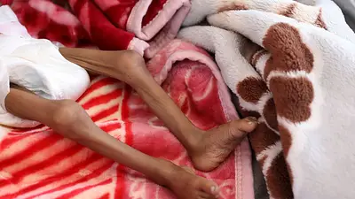 Médicos sin Fronteras advierte de desnutrición en Yemen tras los recortes de fondos Médicos sin Fronteras advierte de desnutrición en Yemen tras los recortes de fondos