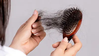 Caída del pelo Caída del pelo