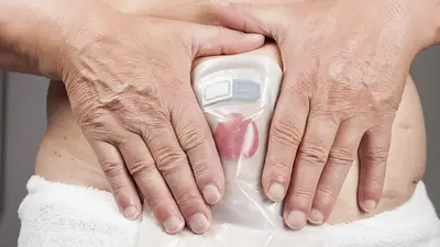 Ostomía Ostomía