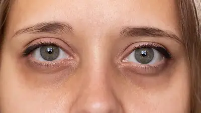 Cómo tapar las ojeras y lograr una mirada más fresca, después de los 30 años Cómo tapar las ojeras y lograr una mirada más fresca, después de los 30 años