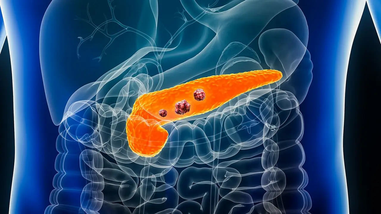 ¿Un paso hacia la cura? Científicos eliminaron el cáncer de páncreas en ratones