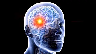 Epilepsia Epilepsia