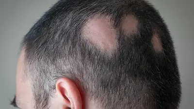 Enfermedades, salud, estrés, caída del pelo Enfermedades, salud, estrés, caída del pelo