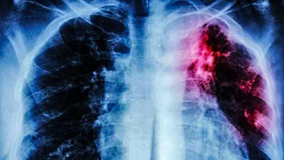 La OMS advirtió que aumentan las muertes por tuberculosis en todo el mundo La OMS advirtió que aumentan las muertes por tuberculosis en todo el mundo
