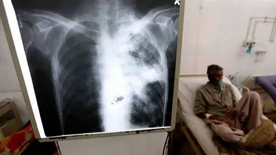Tuberculosis: qué es y cómo se contagia Tuberculosis: qué es y cómo se contagia