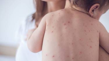 Por el aumento de casos de sarampión en países limítrofes, Formosa insta a completar el esquema de vacunación