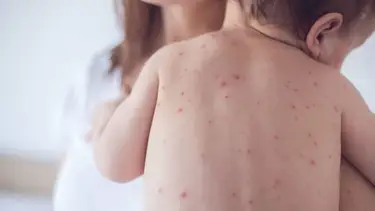 Por el aumento de casos de sarampión en países limítrofes, Formosa insta a completar el esquema de vacunación