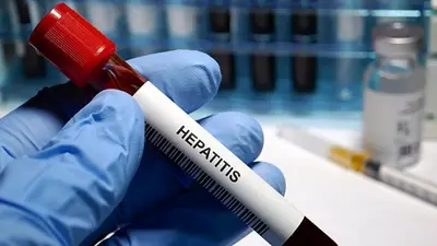 Brote de Hepatitis aguda: los consejos de la Sociedad Argentina de Pediatría Brote de Hepatitis aguda: los consejos de la Sociedad Argentina de Pediatría