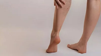 Piernas con y sin varices Piernas con y sin varices