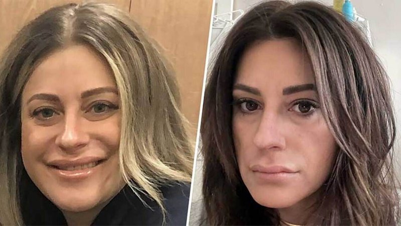 Rostro después de usar Ozempic y antes de utilizar el fármaco