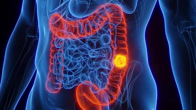 Cáncer de colon Cáncer de colon