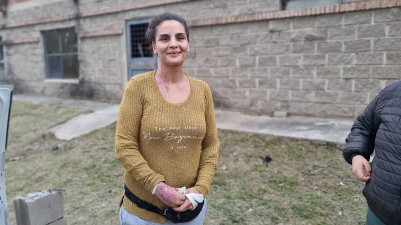 Córdoba: Pamela Cano sobrevivió al intento de femicidio con ácido de su ex y ya está de alta