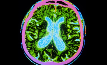 Dos ensayos probaron la seguridad de terapias con células madre para el Parkinson | Ciencia 