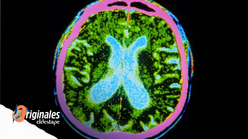 Dos ensayos clínicos probaron la seguridad de tratamientos con células madre para el Parkinson