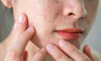 Rosácea y frío: especialistas advierten sobre brotes más intensos y dan pautas para cuidar | Salud