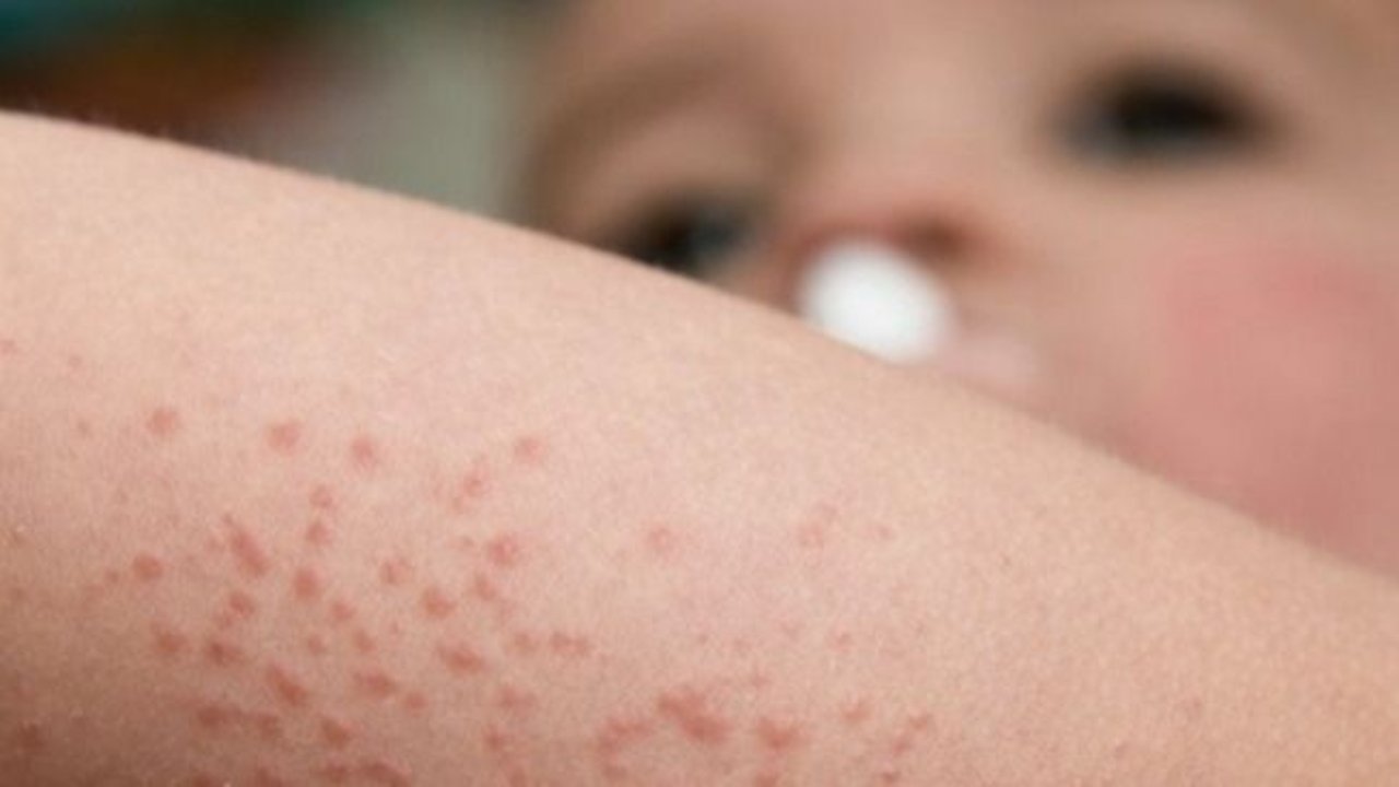 Dermatitis atópica: lanzaron una campaña de detección gratuita en todo el país