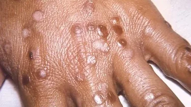 Detectan "viruela del mono" en varios países europeos