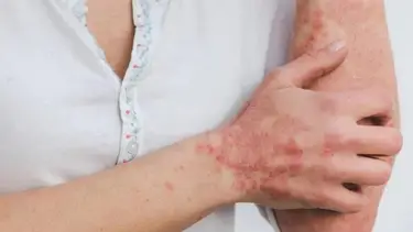 Vuelven las cuarentenas en el mundo por la viruela del mono
